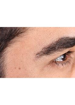 After Hair Transplant&nbsp;Eyebrows